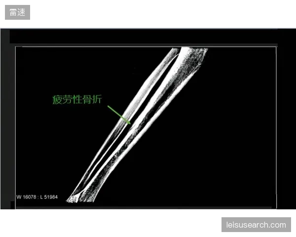 便携式量子磁体扫描仪将把疲劳性骨折的预警期提前两周